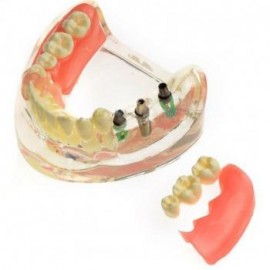 Modelo dental M-6006 Restauración de implantes