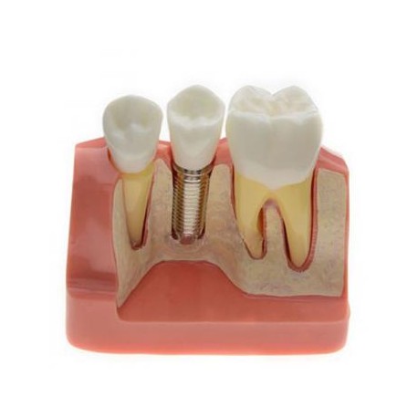 Modelo de Análisis implante corona dental M-2017
