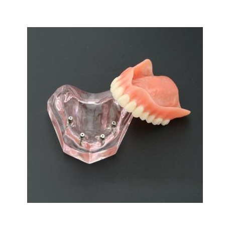 Modelo de Práctica Dental 4 Implantes Demostración Superior Modelo de Sobredentadura Superior 6001 01