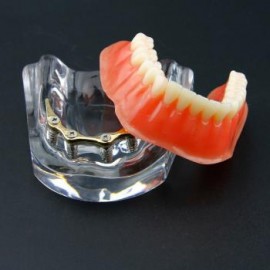 Dental Sobredentadura Typodont Modelo Inferior Precision Implant Dorado 6009